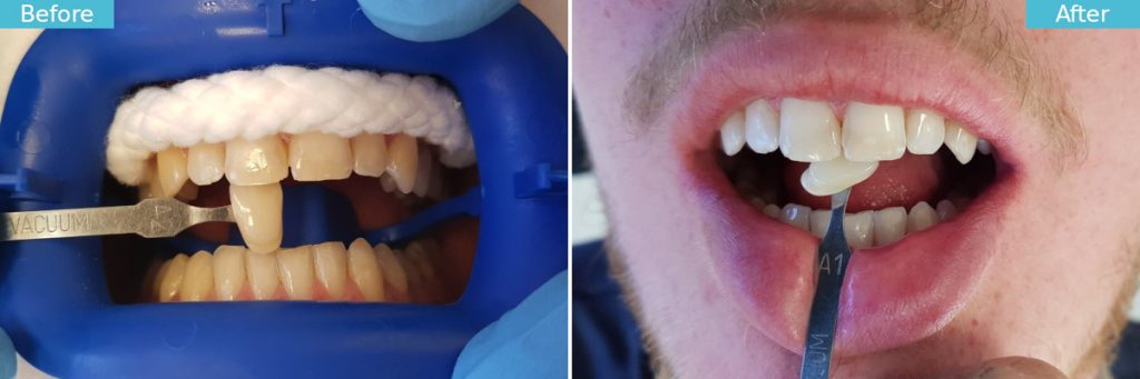 Whitening Before and After